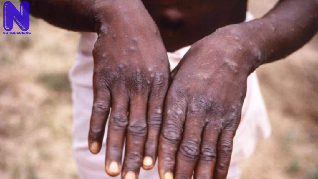 Bauchi records outbreak of monkeypox as Government urge residents not to panic A4BLBKJD46065