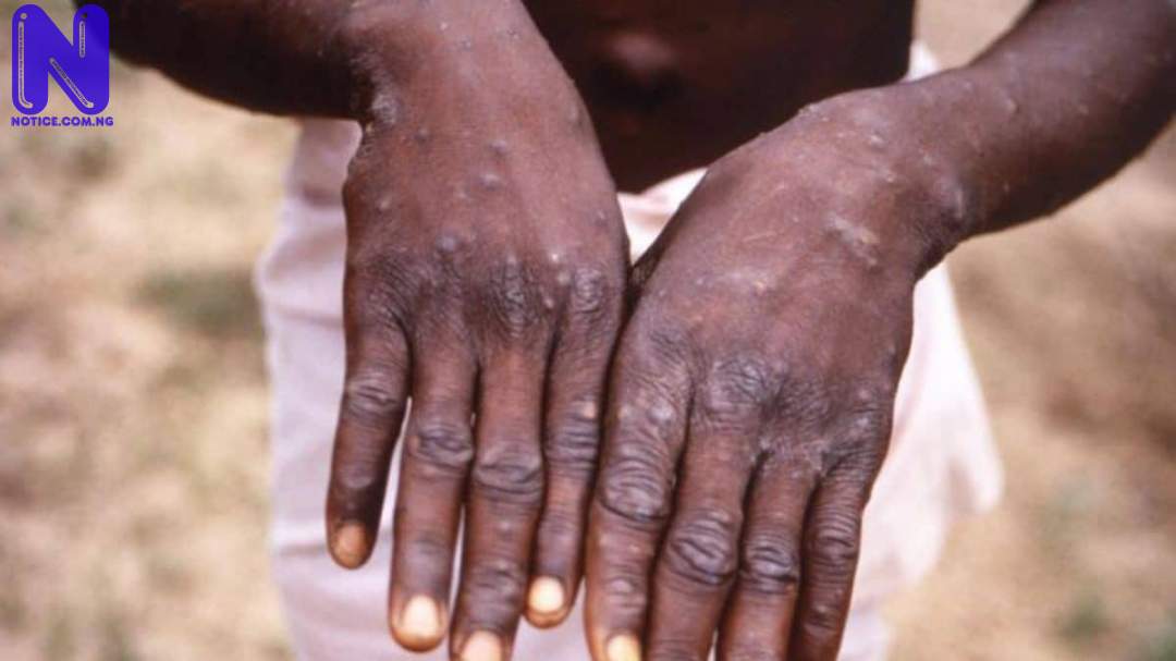 Ogun confirms one case of Monkeypox A4BLBKJD46065
