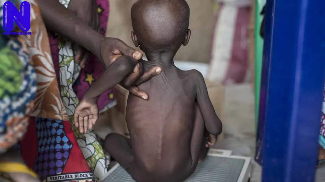 ACUTE-MALNUTRITION-IN-CHILDREN