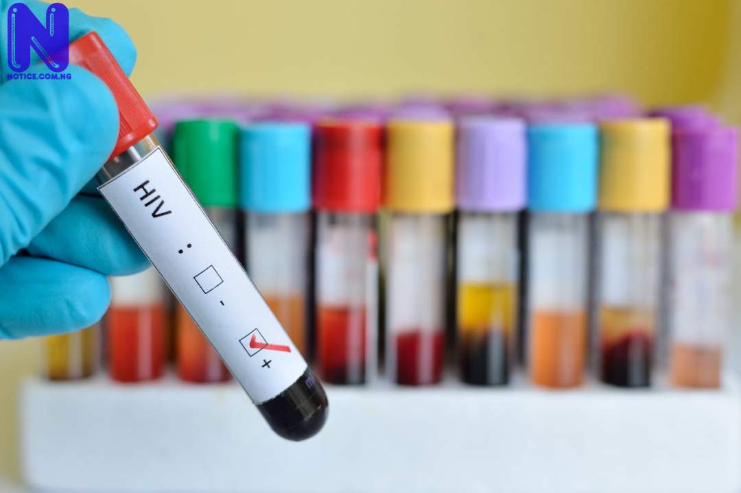 4,531 sex workers tested for HIV in Ogun SYMPTOMS-OF-HIV-INFECTION-183783